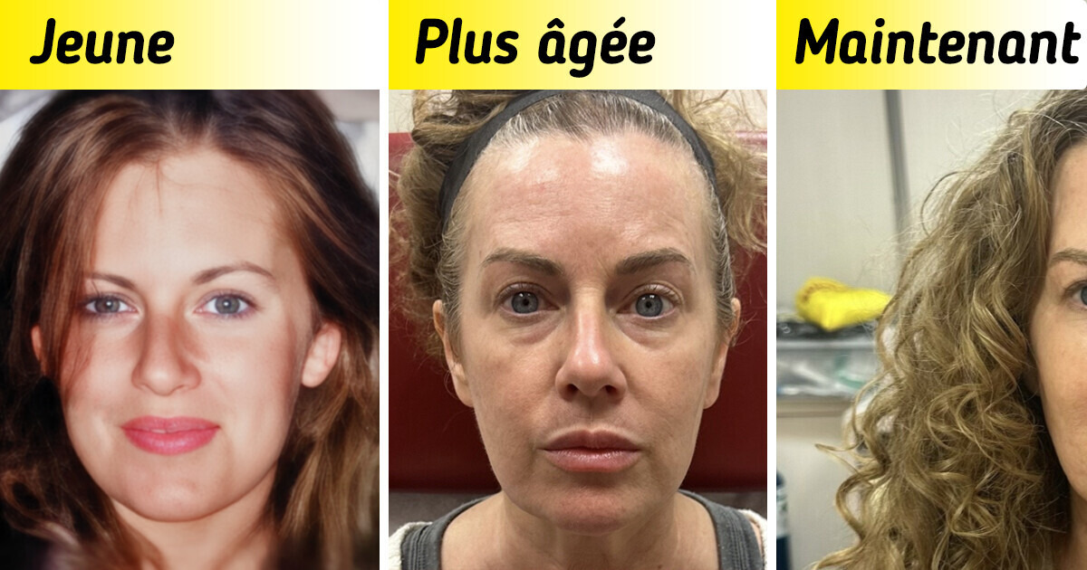 Une femme a utilisé du Botox parce quelle voulait ressembler à elle