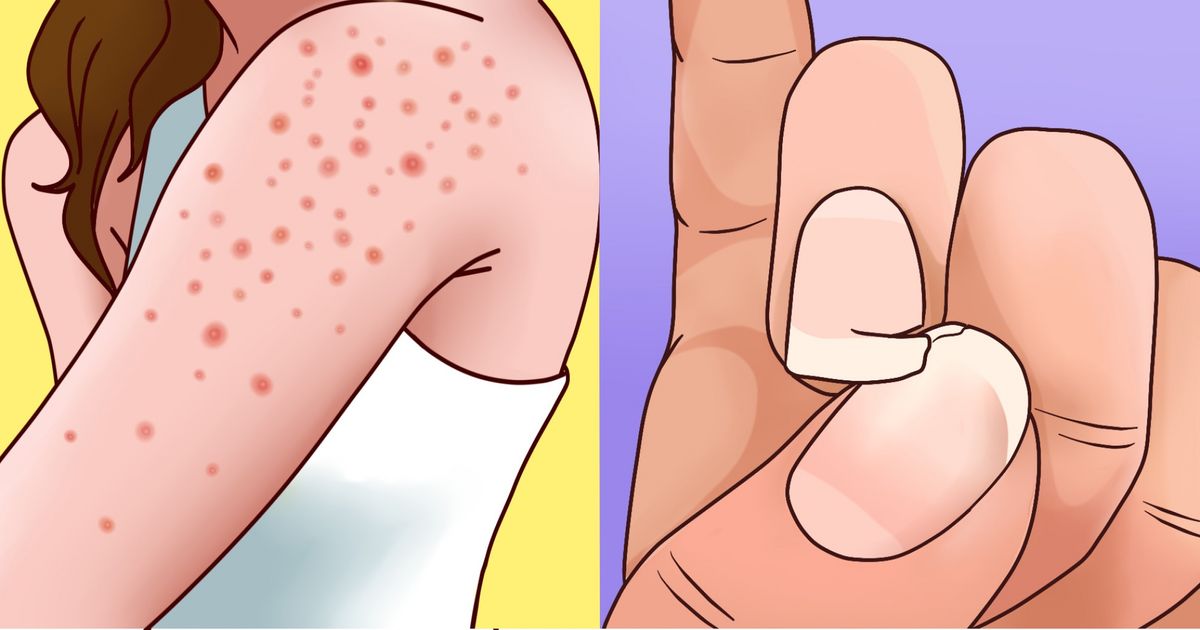 9 Signes qui montrent une allergie au gluten