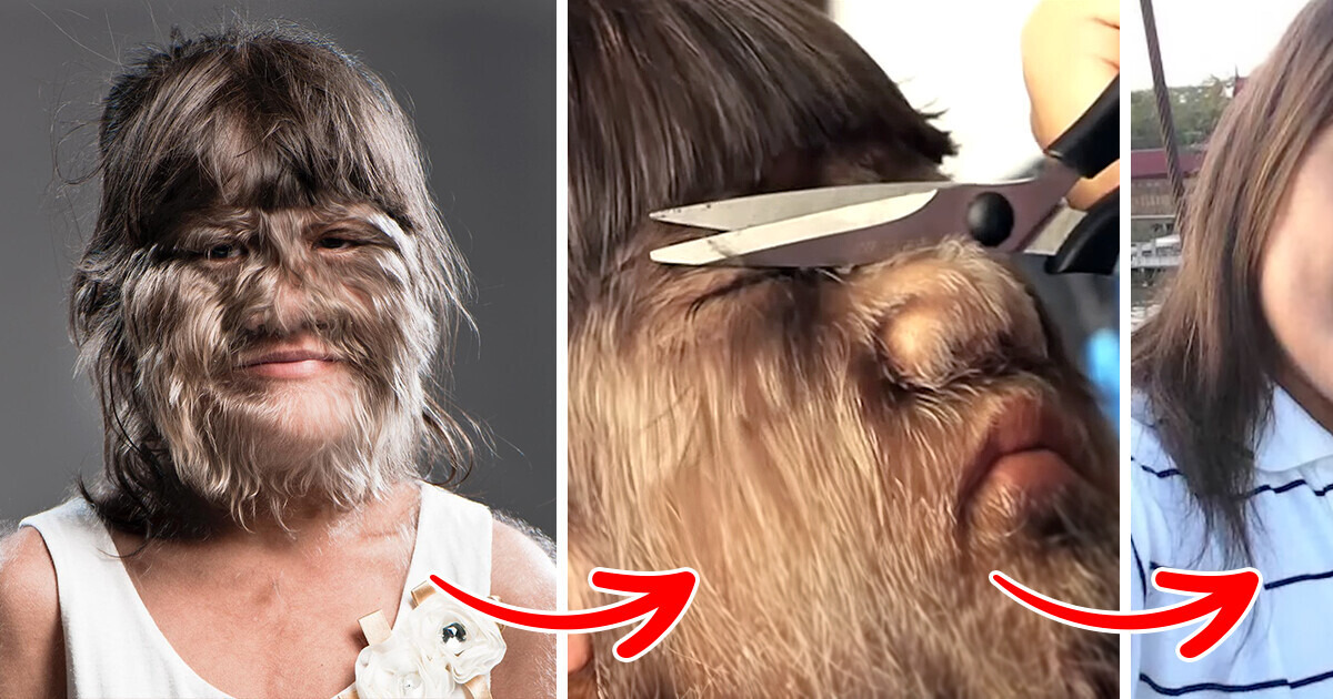 La fille la plus poilue du monde a grandi, est en couple et arbore son nouveau style après s’être rasée La fille la plus poilue du monde a grandi, est en couple et arbore son nouveau style après s’être rasée