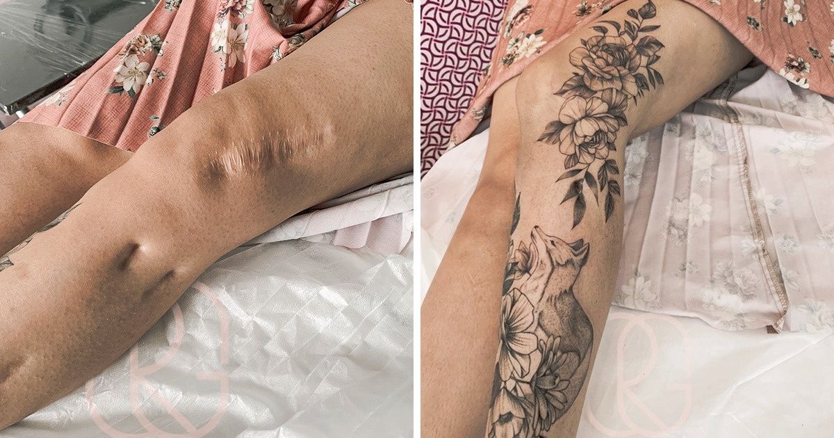 16 Personnes qui ont transformé leurs cicatrices en œuvres d’art
