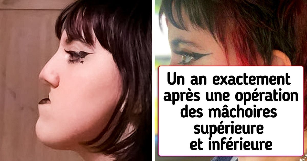 19 Personnes qui ont décidé un jour d’avoir recours à la chirurgie plastique et qui en ont été satisfaites 19 Personnes qui ont décidé un jour d’avoir recours à la chirurgie plastique et qui en ont été satisfaites