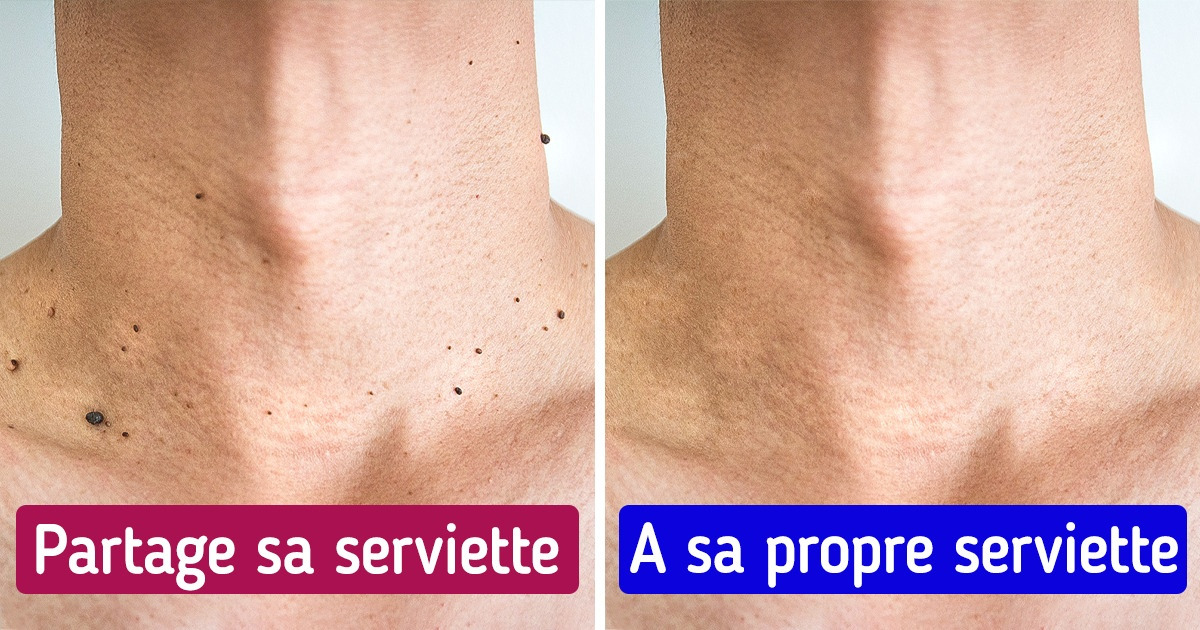 6 Moyens simples et efficaces de lutter contre les verrues