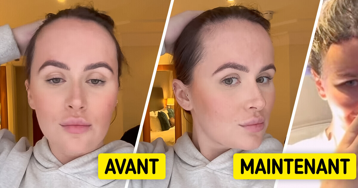 Une femme décide de faire une opération de réduction du front après avoir été humiliée Une femme décide de faire une opération de réduction du front après avoir été humiliée