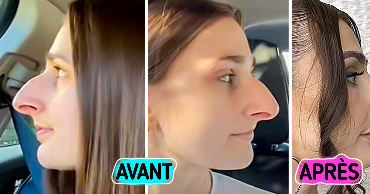 Elle met 10 ans à économiser pour sa rhinoplastie - les résultats sont impressionnants Elle met 10 ans à économiser pour sa rhinoplastie - les résultats sont impressionnants