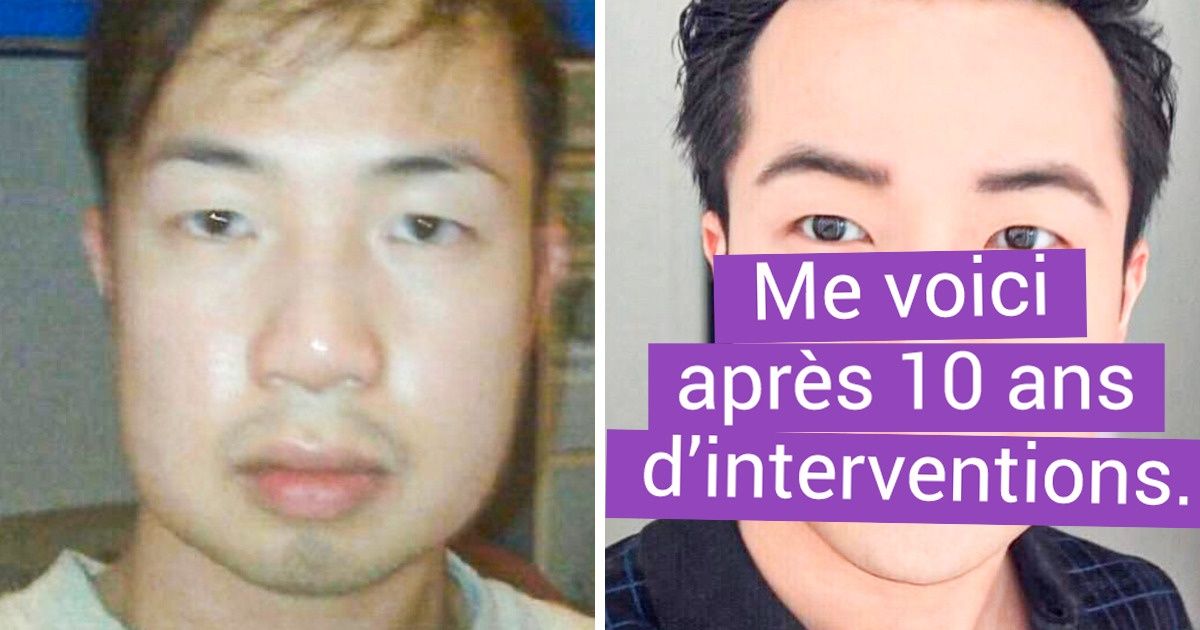 20 Personnes qui n’ont pas regretté de s’être tourné vers la chirurgie esthétique pour se sentir mieux 20 Personnes qui n’ont pas regretté de s’être tourné vers la chirurgie esthétique pour se sentir mieux