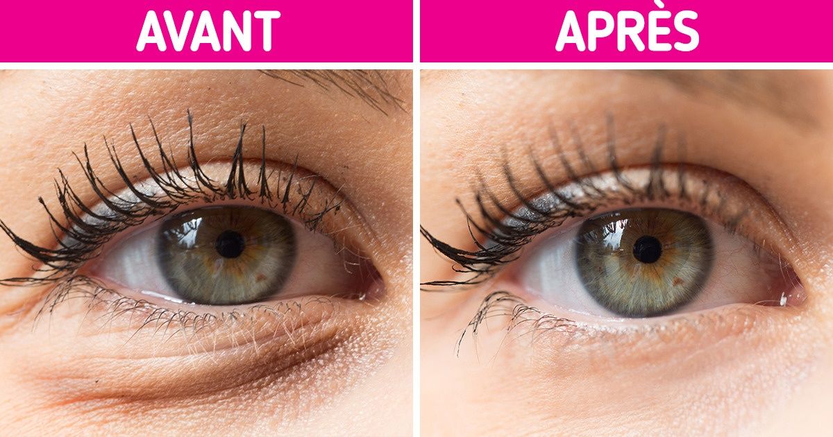 Pourquoi nous avons des cernes sous les yeux et comment s’en débarrasser
