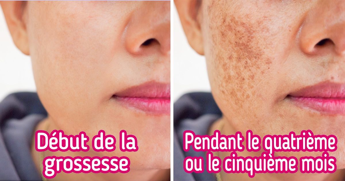 Pourquoi des taches peuvent apparaître sur ton visage pendant la grossesse ?