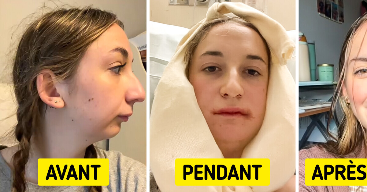 Une jeune femme révèle les résultats spectaculaires de son opération de la mâchoire, laissant