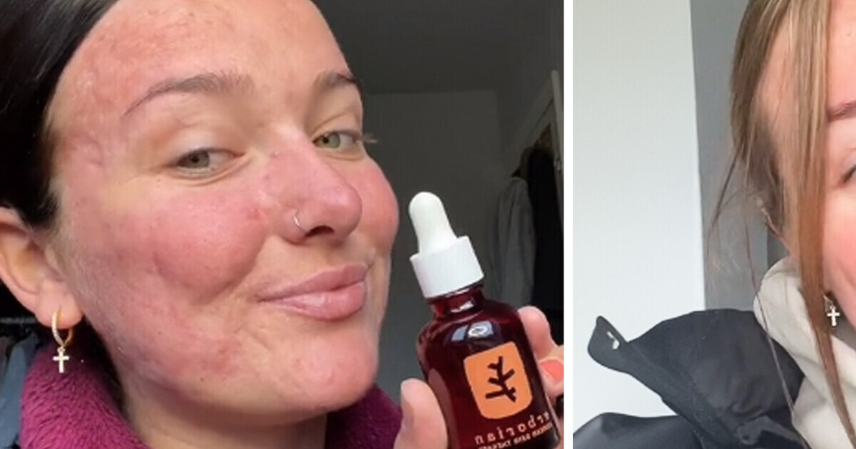 Après un long combat contre l’acné, elle devient influenceuse beauté pour inspirer les autres Après un long combat contre l’acné, elle devient influenceuse beauté pour inspirer les autres