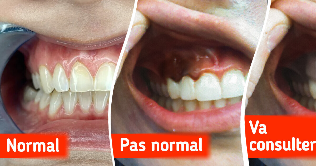 5 Choses alarmantes que tes gencives peuvent dire sur ta santé 5 Choses alarmantes que tes gencives peuvent dire sur ta santé