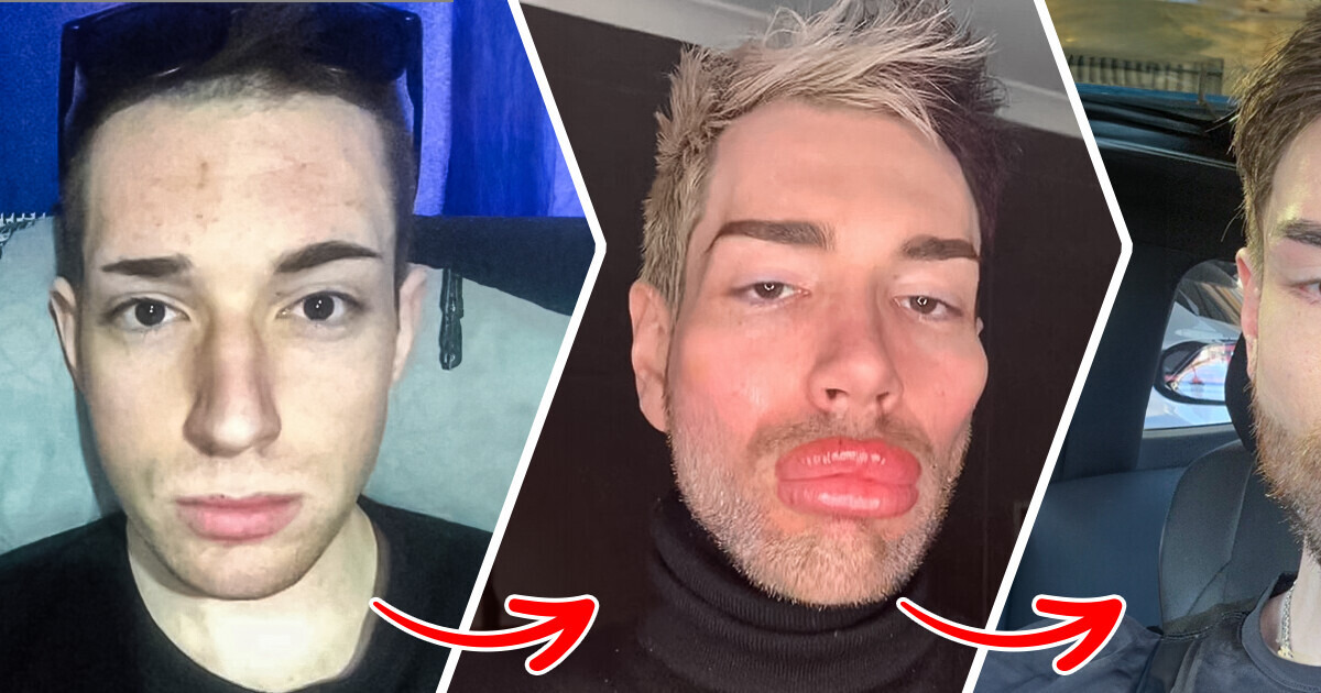 Il retire 13 ml de comblement facial et étonne tout le monde par sa transformation