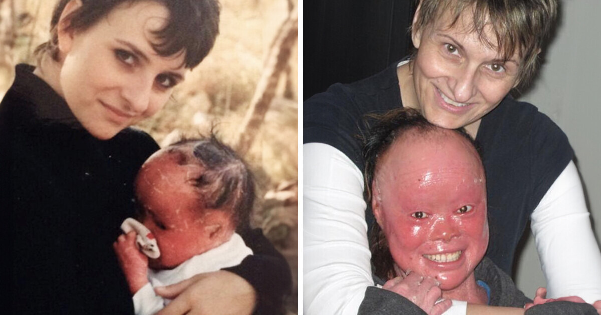 Un couple adopte une fillette à la peau rouge qui avait peu de chances de survivre et en fait une championne