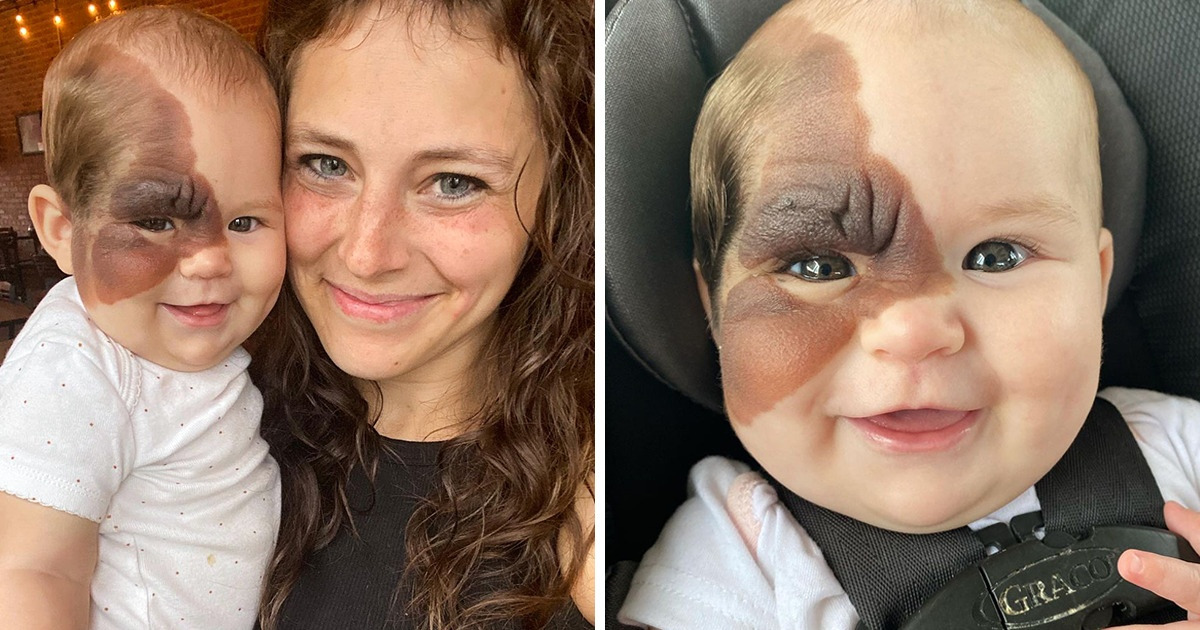 La petite Winry est née avec une tache de naissance rare, et sa maman partage à quel point sa fillette est belle
