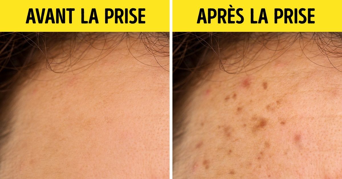 Les médicaments que tu ne devrais pas prendre si tu vas t’exposer au soleil