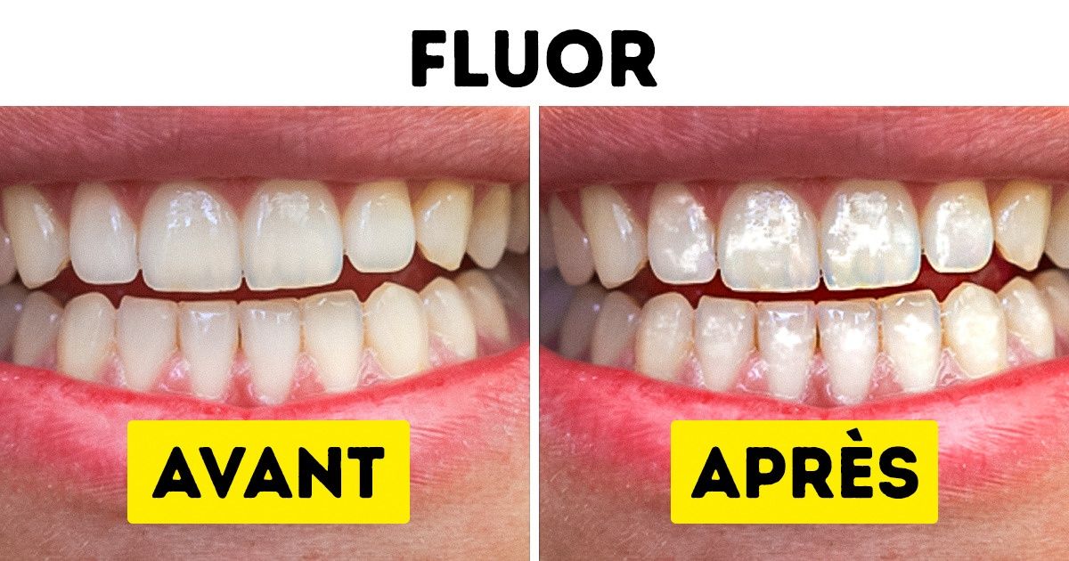 10 Produits populaires qui causent des dommages irréparables à tes dents 10 Produits populaires qui causent des dommages irréparables à tes dents
