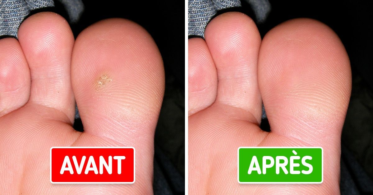 8 Méthodes pour se débarrasser des verrues naturellement 8 Méthodes pour se débarrasser des verrues naturellement