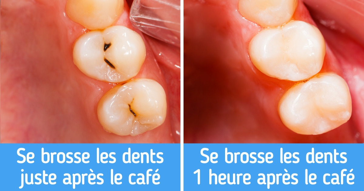 7 Astuces pour avoir des dents blanches et en bonne santé