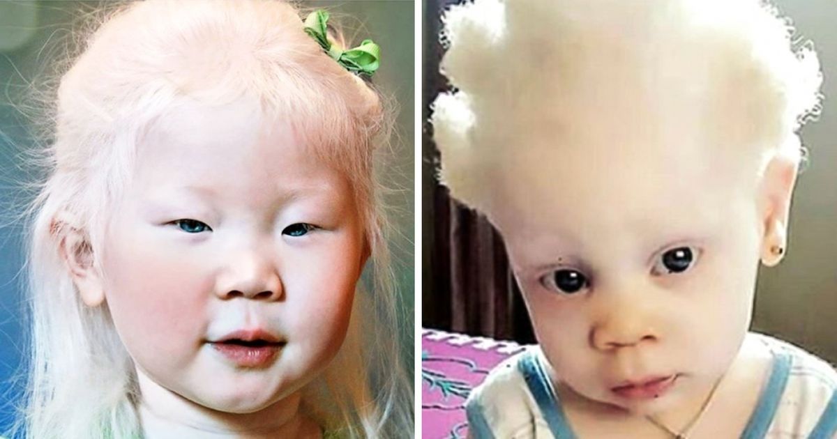 Découvre à quoi ressemblent les albinos de différentes origines à travers le monde