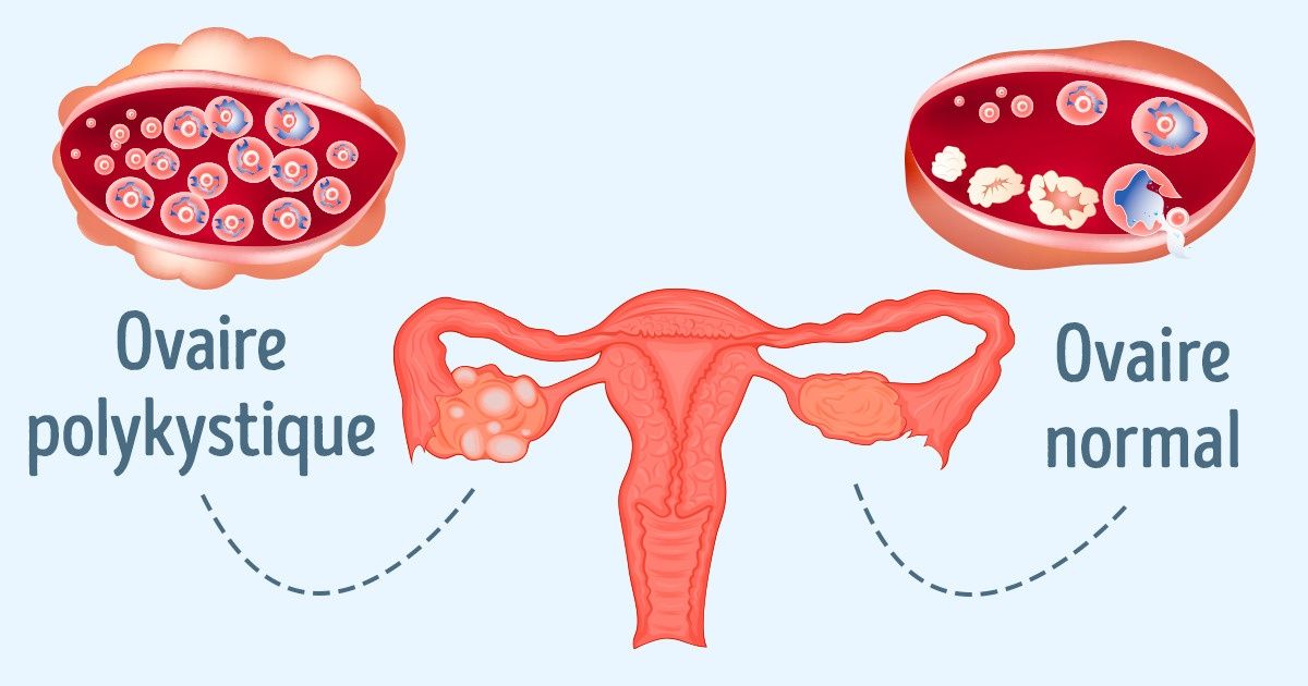 10 raisons de faire attention au syndrome des ovaires polykystiques