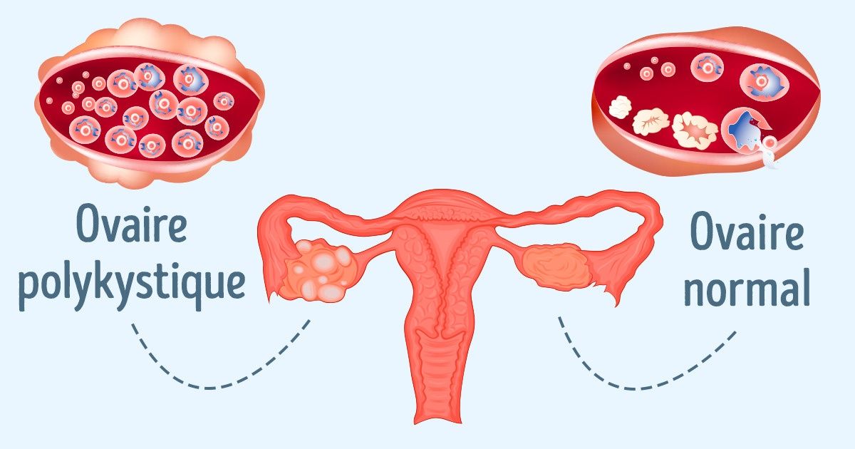 Endocrino especialista en ovarios poliquisticos