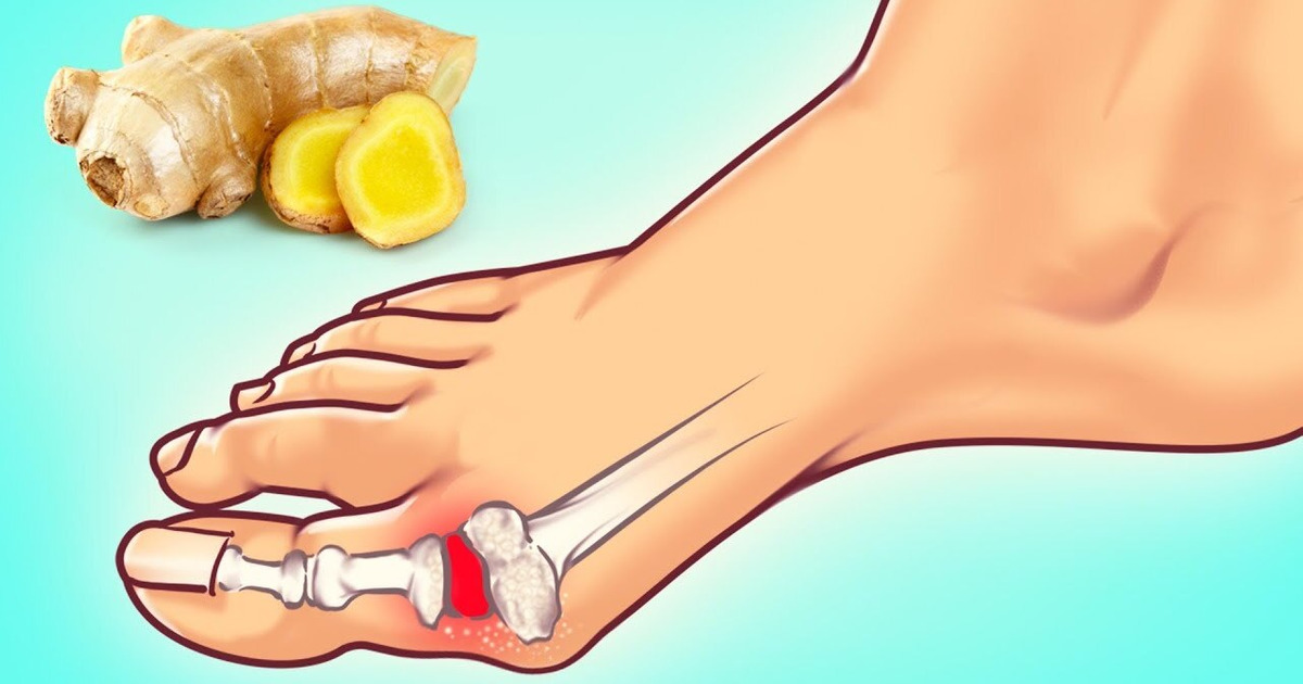 10 Astuces D’experts Pour Combattre Une Crise de Goutte 10 Astuces D’experts Pour Combattre Une Crise de Goutte