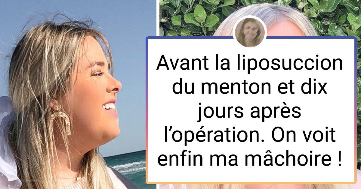18 Personnes qui ont décidé de se soumettre à une intervention chirurgicale pour effacer leurs complexes