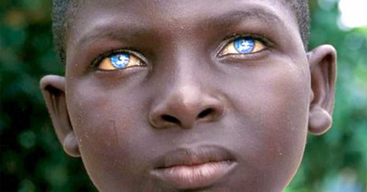 Ces 11 superbes particularités physiques sont en fait des anomalies génétiques Ces 11 superbes particularités physiques sont en fait des anomalies génétiques