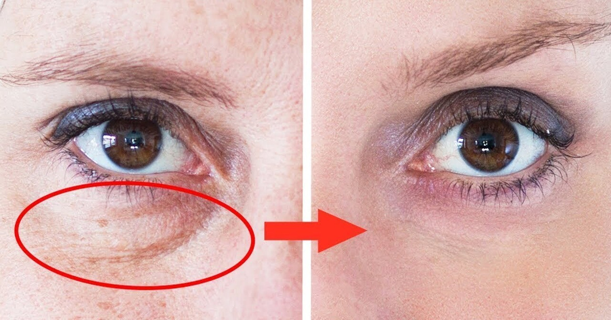 Se Débarrasser Des Cernes Sous Les Yeux en Seulement 3 Jours