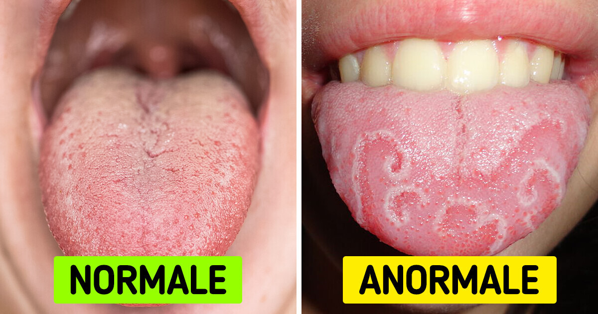 Qu'est-ce que la langue blanche et ce qu'il faut faire pour y remédier Qu'est-ce que la langue blanche et ce qu'il faut faire pour y remédier