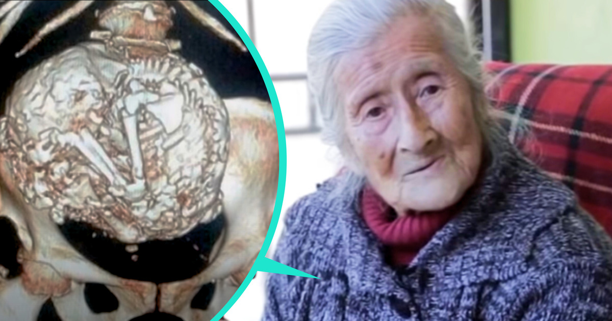 Cette femme âgée était souffrante à cause d’un fœtus vieux de 50 ans Cette femme âgée était souffrante à cause d’un fœtus vieux de 50 ans