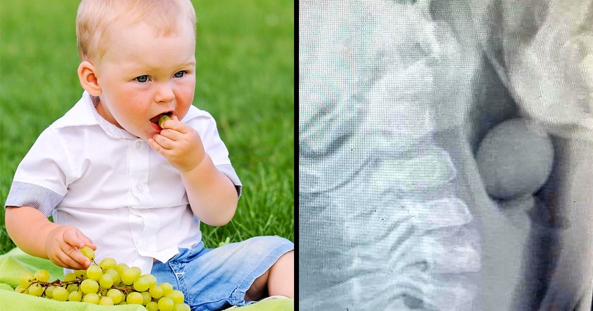 Une mère a partagé une radiographie de son enfant avec un raisin coincé dans la gorge que tous les parents devraient voir Une mère a partagé une radiographie de son enfant avec un raisin coincé dans la gorge que tous les parents devraient voir