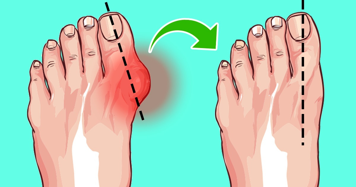 6 Manières simples de réduire tes oignons aux pieds sans avoir recours à la chirurgie
