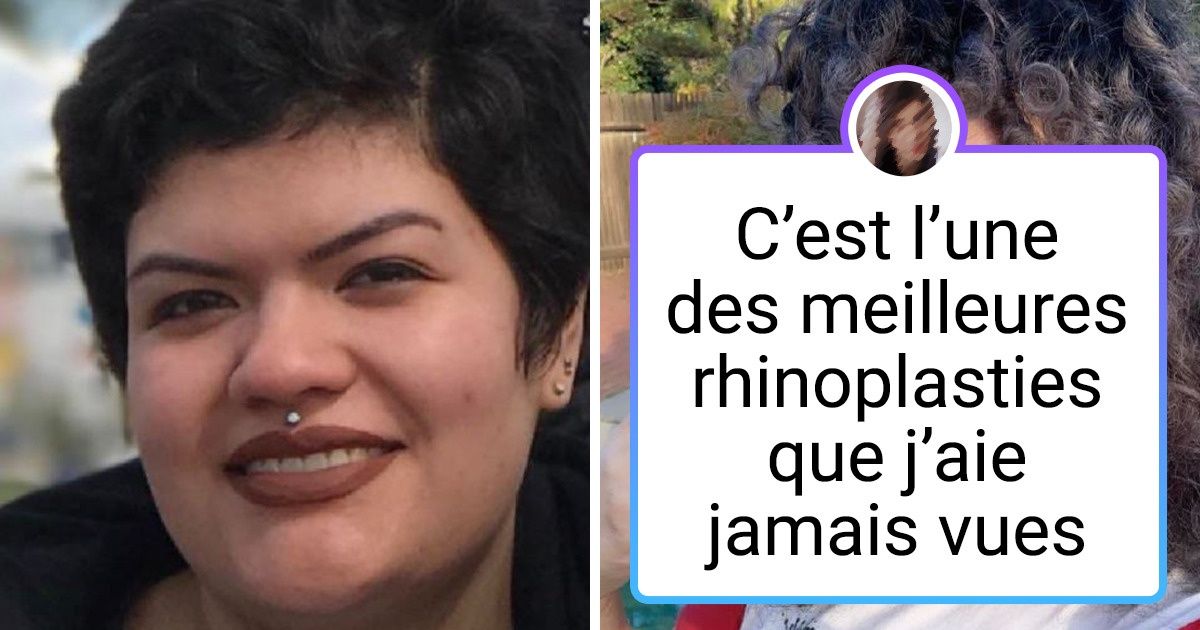 18 Personnes qui ont opté pour une chirurgie esthétique et sont très contentes du résultat