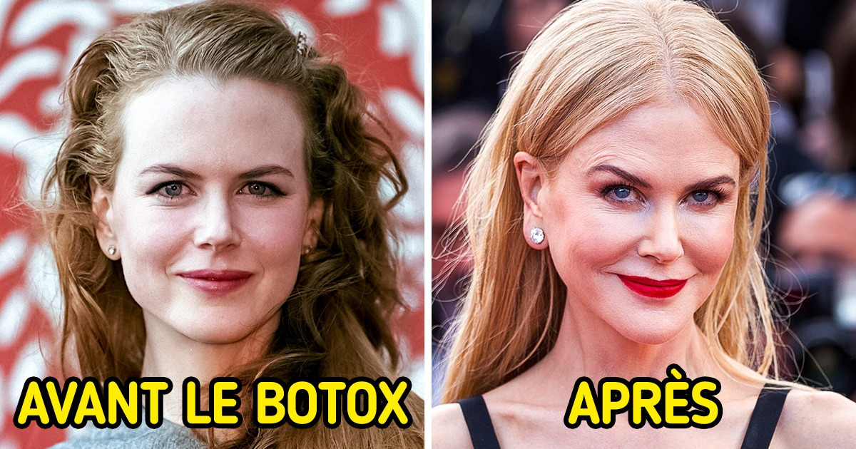 Botox avant et après célébrité