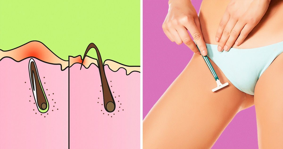 Comment se débarrasser des poils incarnés et éviter qu’ils ne reviennent Comment se débarrasser des poils incarnés et éviter qu’ils ne reviennent