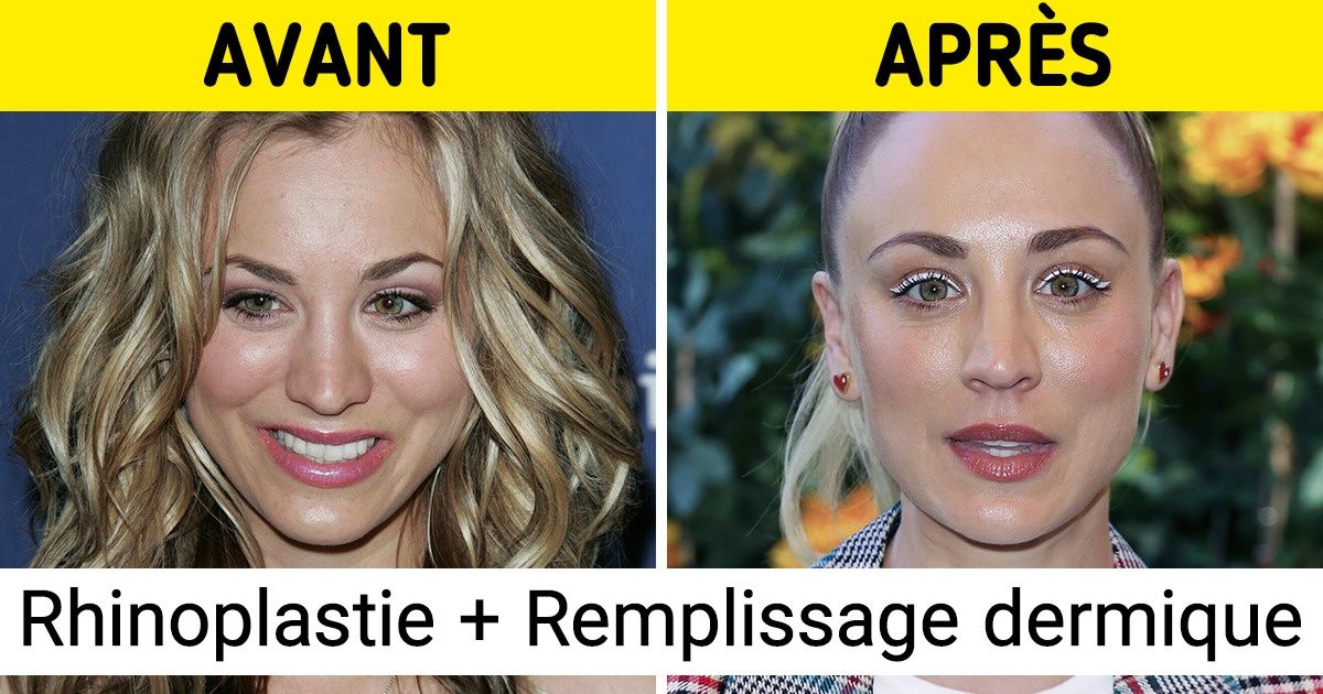 17 Stars qui n’ont pas hésité à avoir recours à la chirurgie esthétique pour s’embellir 17 Stars qui n’ont pas hésité à avoir recours à la chirurgie esthétique pour s’embellir
