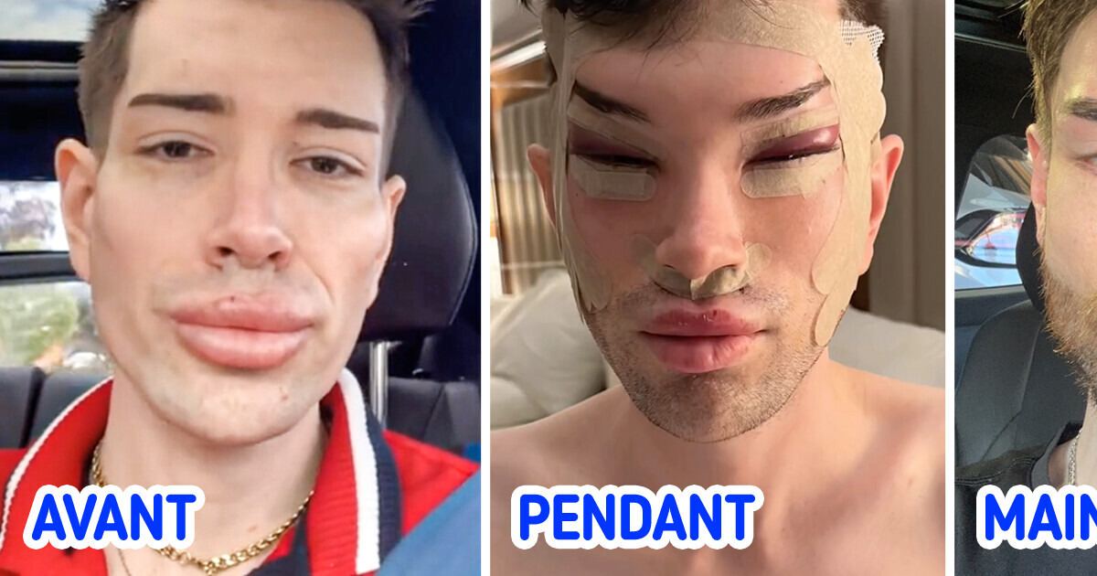 Un homme montre les résultats de sa chirurgie des yeux et du retrait de comblements, la toile en est impressionnée