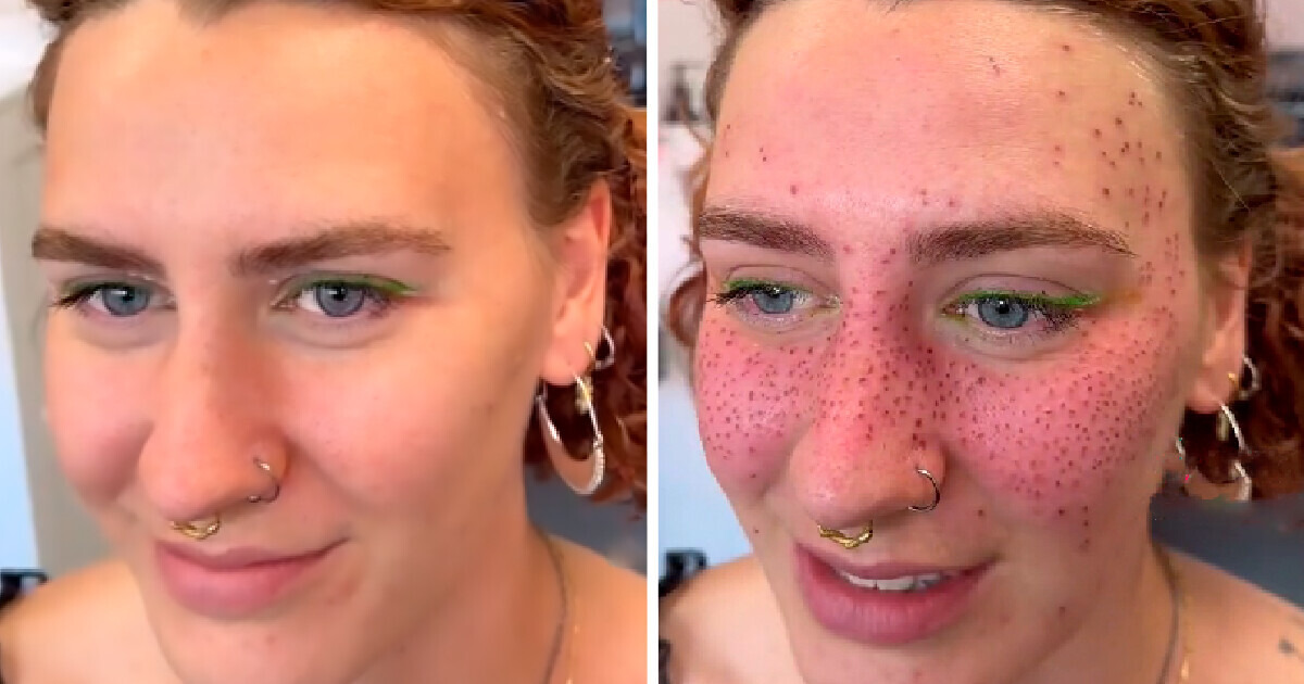 La tendance des “taches de rousseur permanentes” divise la toile