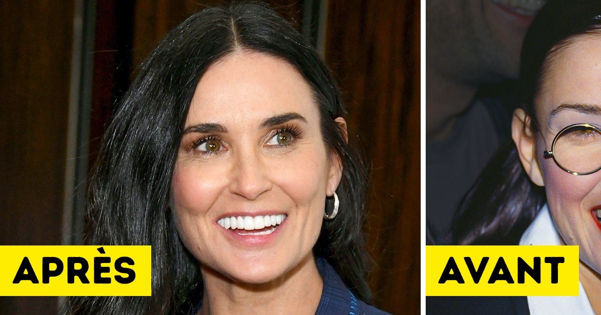 12 Stars qui ont laissé une belle somme chez le dentiste pour s’offrir un sourire hollywoodien