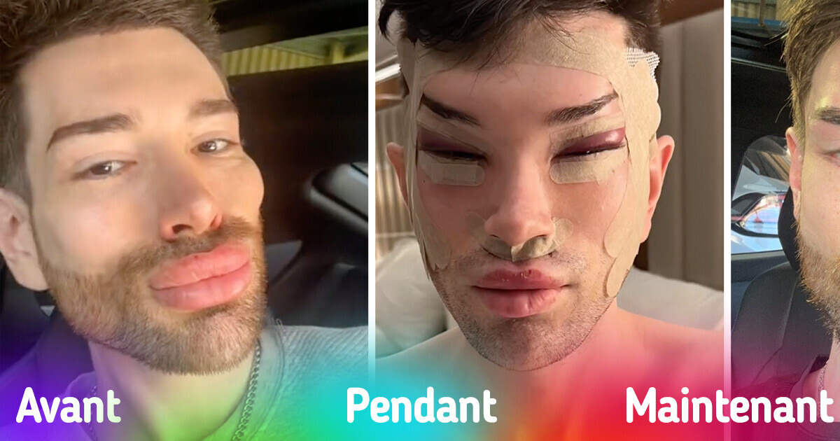 Un homme révèle les résultats d’une chirurgie des yeux et d’un retrait de produits de comblement, laissant les gens stupéfaits