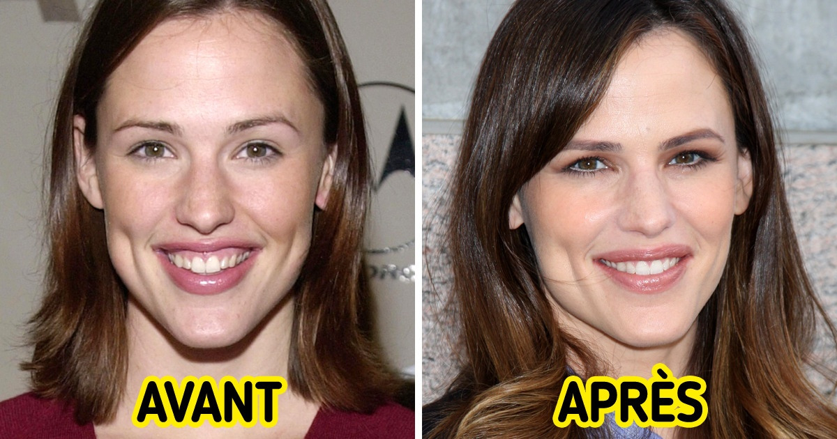17 Célébrités qui sont passées chez le dentiste et sont devenues encore plus radieuses