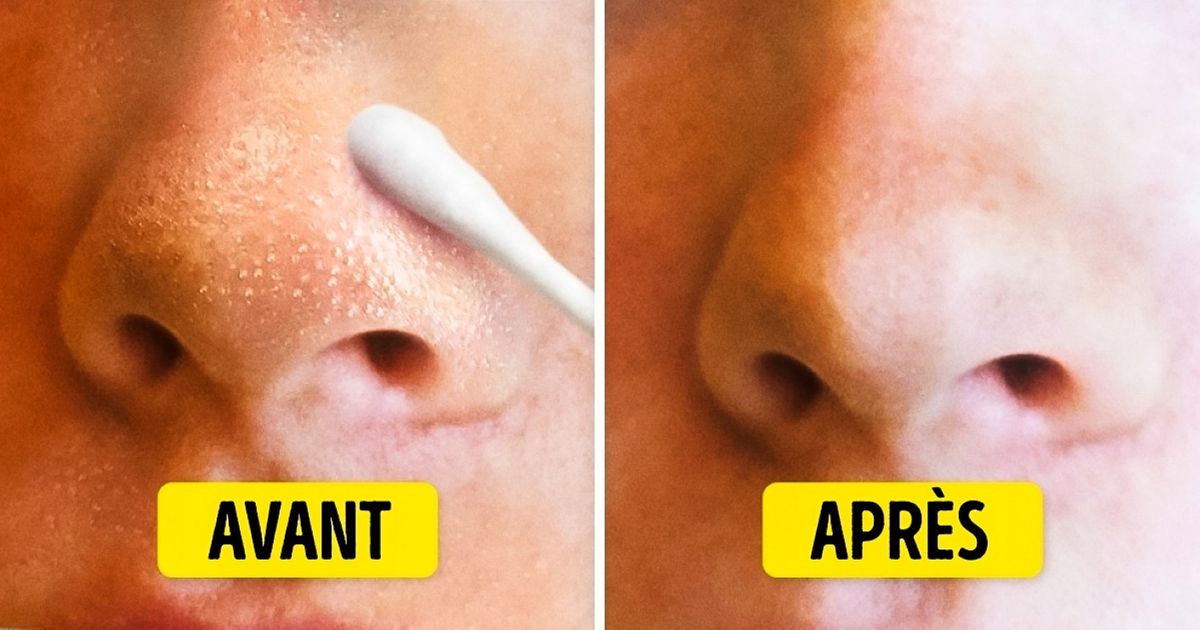 10 Solutions naturelles qui feront disparaître les points noirs