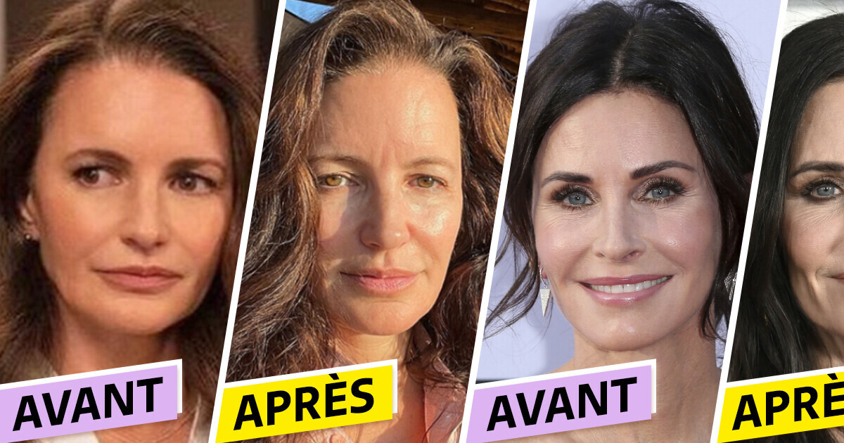 5 Célébrités qui ont retiré leurs produits de comblement du visage et qui ont adoré les résultats 5 Célébrités qui ont retiré leurs produits de comblement du visage et qui ont adoré les résultats