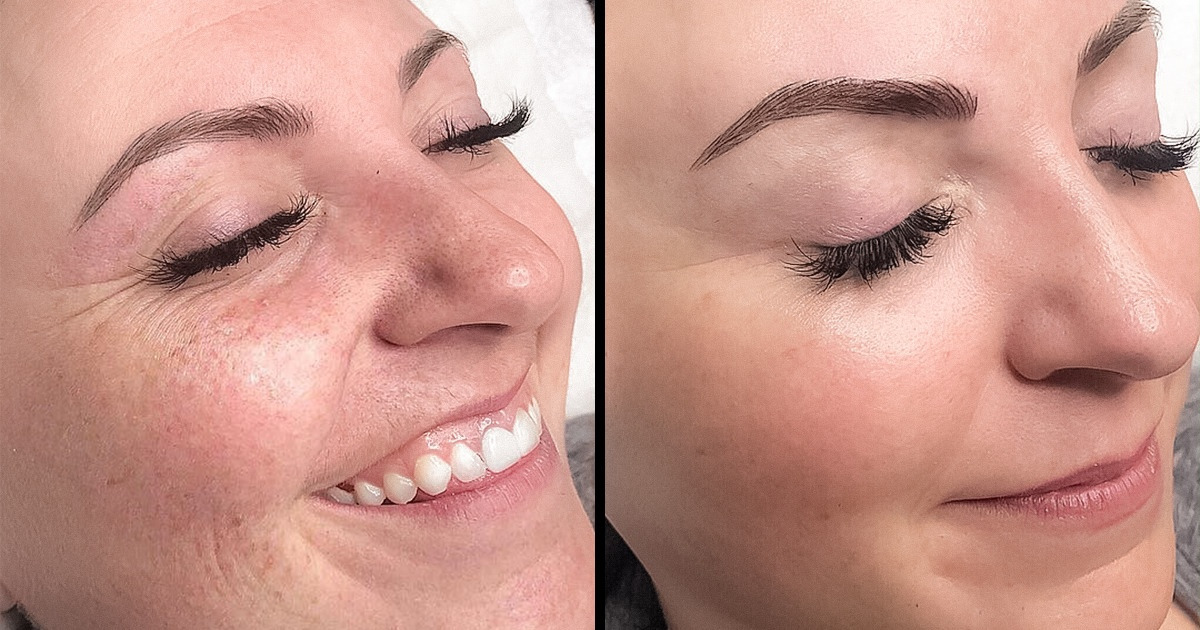 9 Méthodes fiables pour éliminer les pores ouverts sur le visage 9 Méthodes fiables pour éliminer les pores ouverts sur le visage