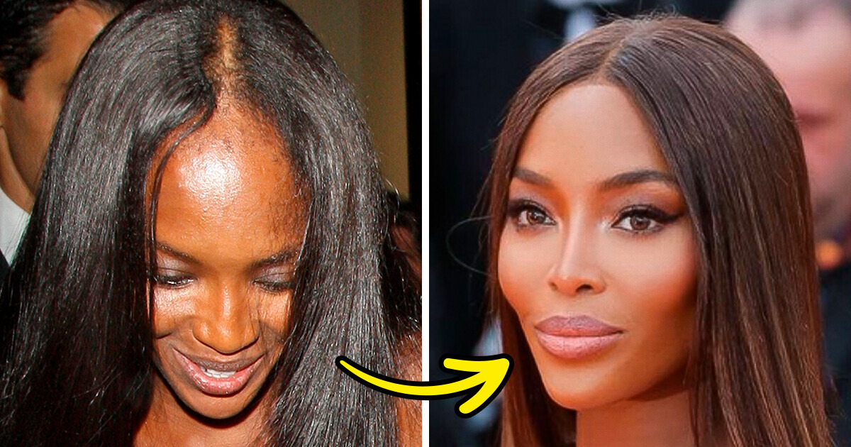 10 Célébrités qui ont choisi la greffe de cheveux pour sublimer leur apparence