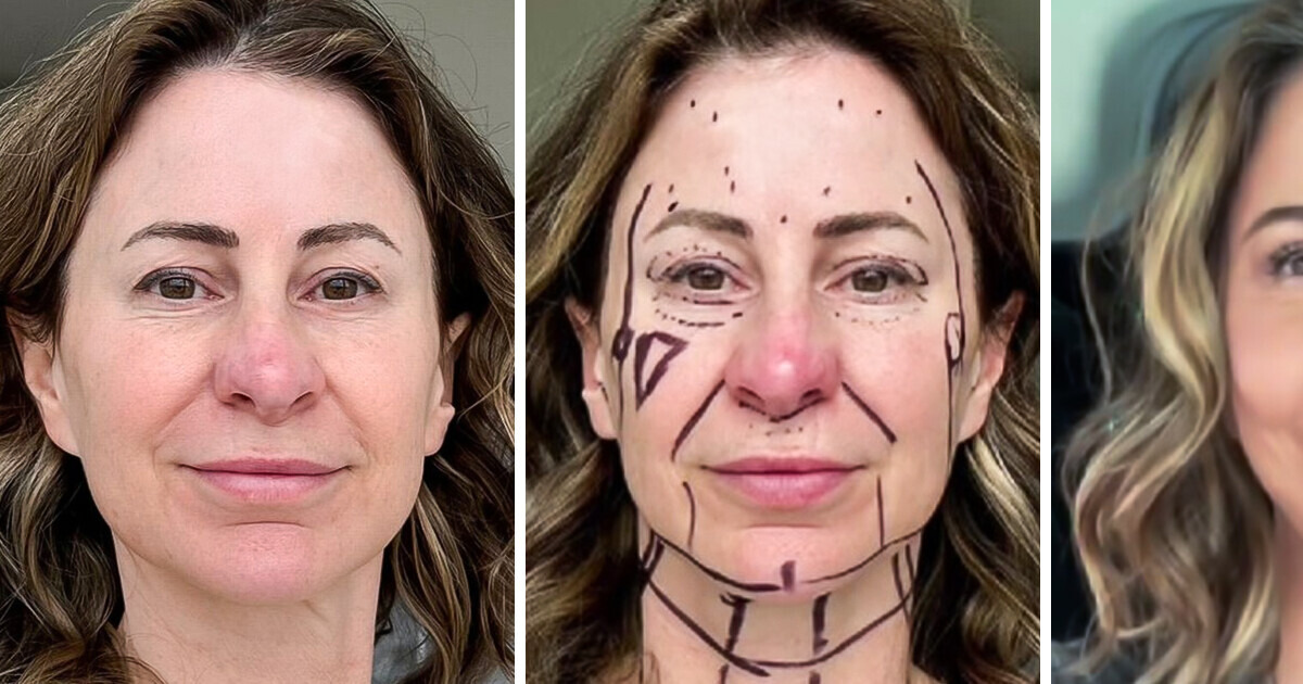 J’ai vendu ma maison pour me faire refaire le visage, j’ai maintenant 20 ans de moins et je vis dans un van J’ai vendu ma maison pour me faire refaire le visage, j’ai maintenant 20 ans de moins et je vis dans un van