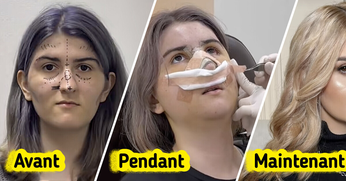 Une femme dévoile sa métamorphose totale après une chirurgie esthétique en Corée du Sud Une femme dévoile sa métamorphose totale après une chirurgie esthétique en Corée du Sud