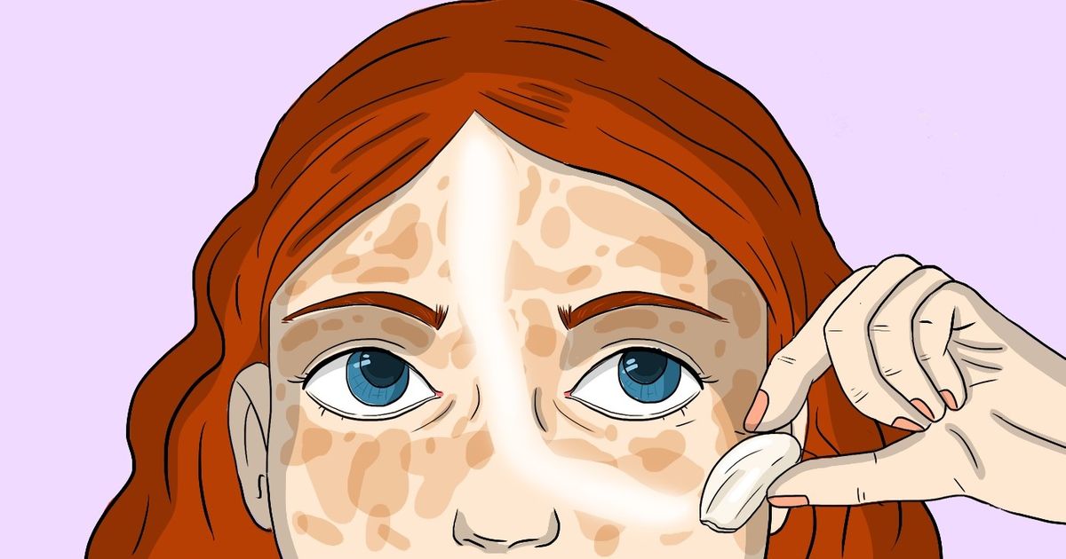 10 Remèdes pour la peau qui enlèveront les taches de pigmentation ...