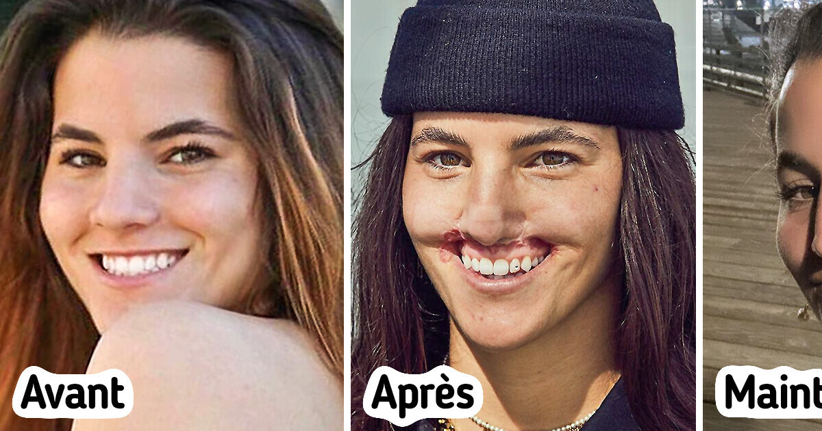 Mordu par un chien, ce courageux mannequin lutte pour accepter son nouveau visage Mordu par un chien, ce courageux mannequin lutte pour accepter son nouveau visage