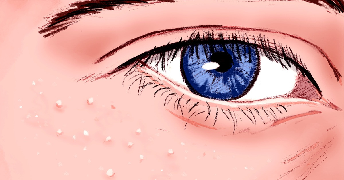 Que sont ces boutons blancs qui apparaissent autour des yeux, et pourquoi ne faut-il pas essayer de les enlever ?